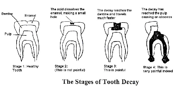 Toothdecaystages.jpg